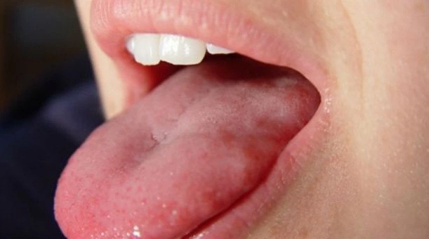 Τι να κάνετε γρήγορα αν δαγκώσετε τη γλώσσα σας